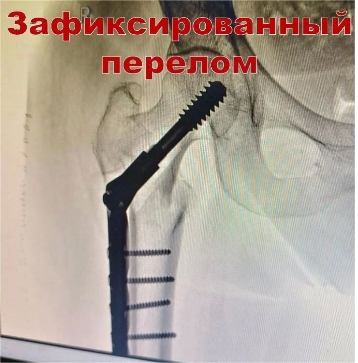 В Усинске сложные переломы теперь лечат без больших разрезов В Усинске сложные переломы теперь лечат без больших разрезов